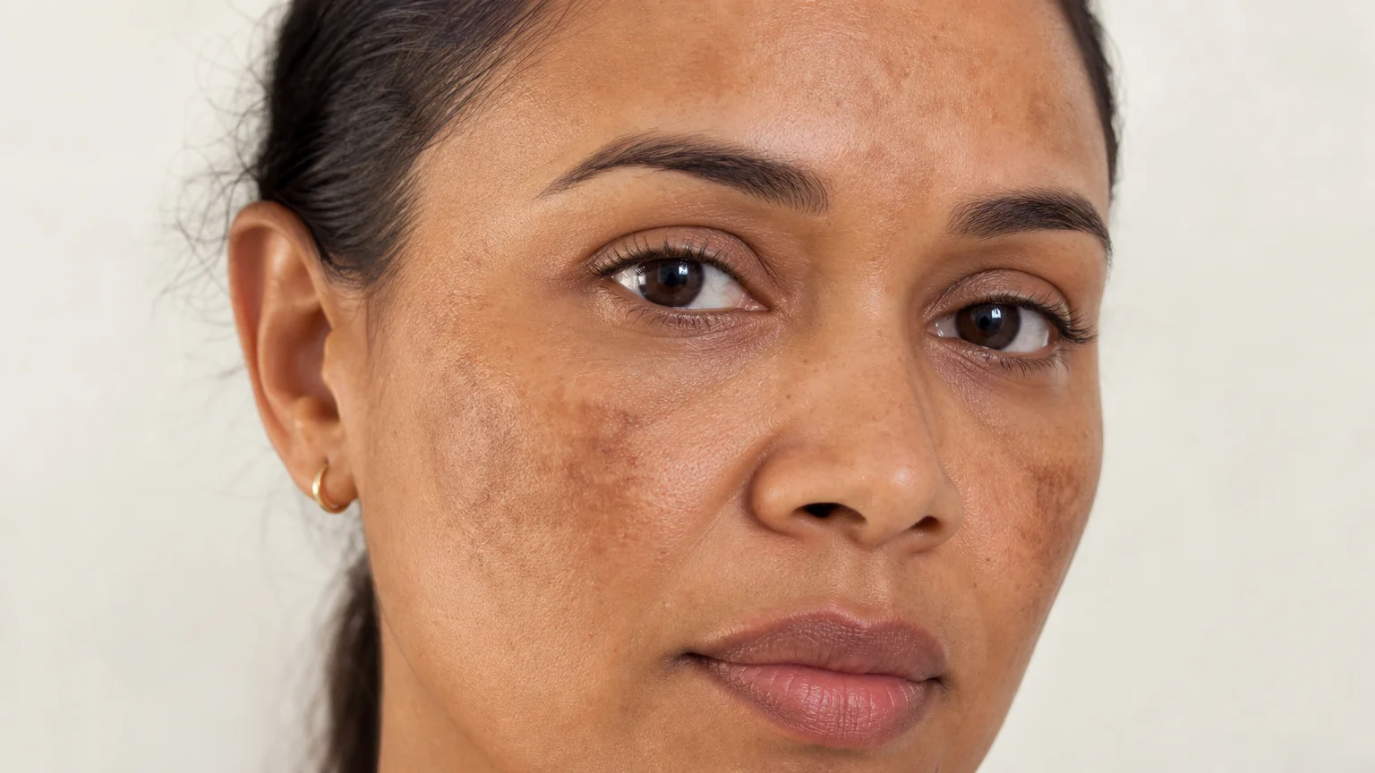 Melasma e manchas de hiperpigmentação no rosto